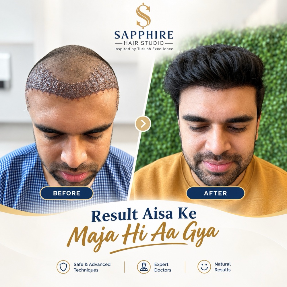 Before and after a hairline transplant
